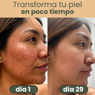 NALUA Serum 2 en 1 Anti Acné y Anti Manchas
