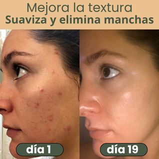 NALUA Serum 2 en 1 Anti Acné y Anti Manchas