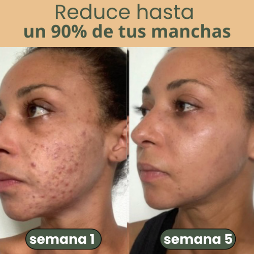 NALUA Serum 2 en 1 Anti Acné y Anti Manchas